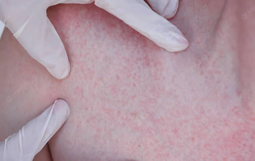 age-spots hives on chest