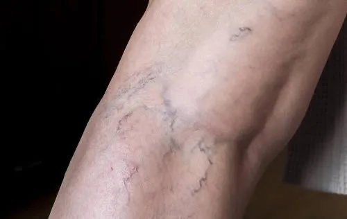 age-spots spider-veins-back-of-leg